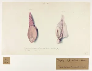 Ducts: Cretaceous Matter in Seminal Duct, Atrophy of Left Testicle