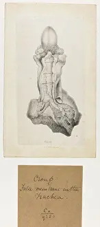 1838: Croup