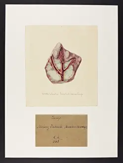 Haemorrhage: Crude Tubercles and Bronchial Haemorrhage