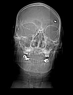 Forensic: CT Scout View, Bullet Fragments