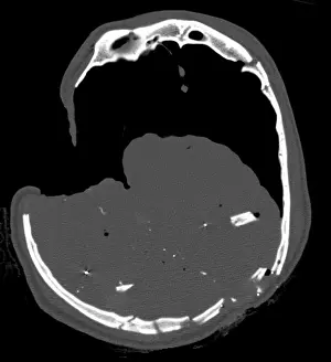 Forensic: CT Section, Gunshot Wound