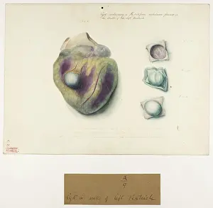 Decr: Cyst in Walls of Left Ventricle