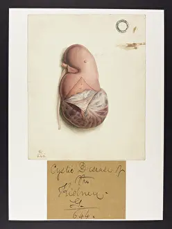 Kidney: Cystic Disease of the Kidney
