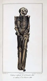 Mathieu: Decomposition On Exhumed Bodies, 1831