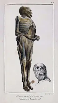 Mathieu: Decomposition On Exhumed Bodies, 1831