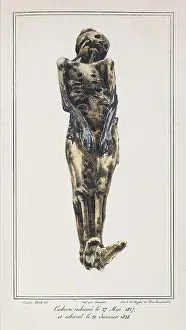 Mathieu: Decomposition On Exhumed Bodies, 1831
