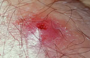 Parasitic: Dermatobia hominis, human botfly