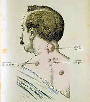 Tested: Development of pustules in a man suffering from
