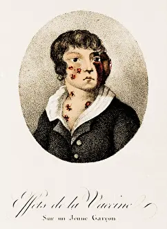 Poorly: Development of Smallpox after Vaccination, 1807