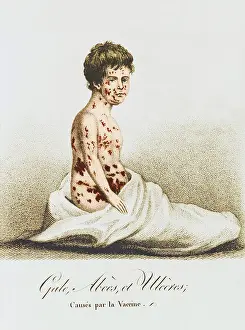 Poorly: Development of Smallpox after Vaccination, 1807