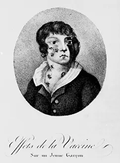 Poorly: Development of Smallpox after Vaccination, 1807