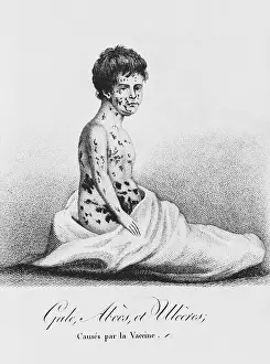 Poorly: Development of Smallpox after Vaccination, 1807