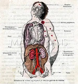 Diabetes: DIABETES SUFFERER