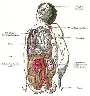 Diabetes: DIAGRAM/DIABETES/1883