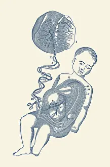 Removal: Diagram of the placenta and umbilical cord attached