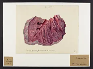 Dilatation: Dilatation of Bronchi