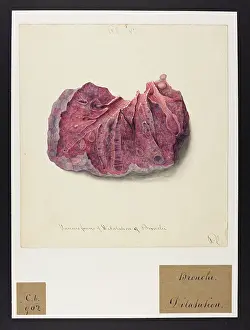Dilatation: Dilatation of Bronchi