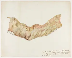 Blank: Diphtheric Ulcers of Mucous Membrane of Large Intestine