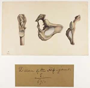Longer: Disease of Hip Joint