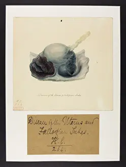 Tubes: Disease of the Uterus and Fallopian Tubes