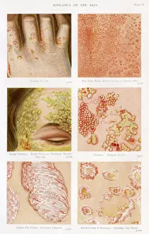 Scabs: Diseases of the Skin - Plate 5