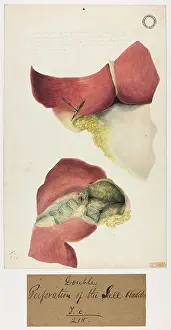 1826: Double Perforation of the Disphragm