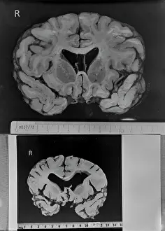 Neuropathologist: Dr Jan Corsellis