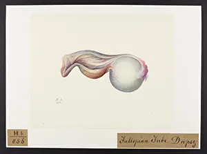 Unsigned: Dropsy: Fallopian Tuve
