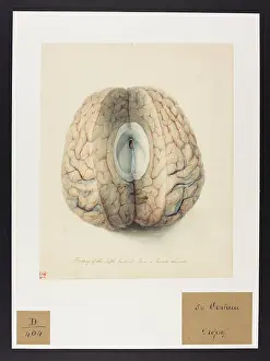 Femmes: Dropsy of the Fifth Ventricle