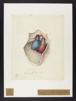 Pericardium: Dropsy of the Pericardium