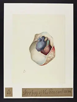 Pericardium: Dropsy of the Pericardium