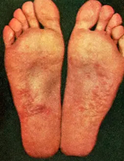 Acute: Dyshidrosis
