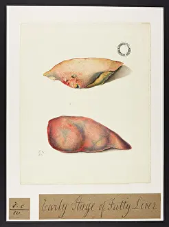 Liver: Early Stage of Fatty Liver