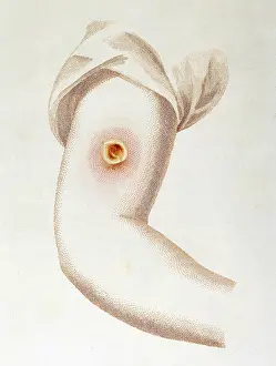 Smallpox: Edward Jenner, Cowpox Pustule, 1798