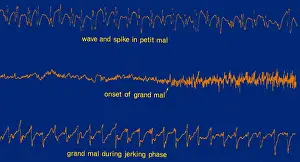 Output: EEG of Epileptic Seizures