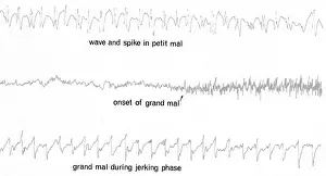 Output: EEG of Epileptic Seizures