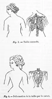 Deformity: Effect of wearing a Corset on the human body