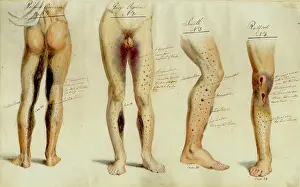 Scurvy: Effects of Scurvy