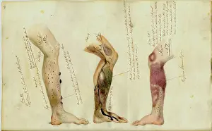 Scurvy: Effects of Scurvy