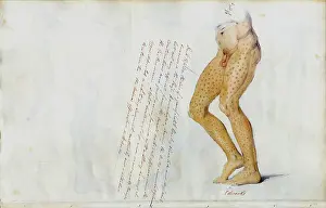 Scurvy: Effects of Scurvy