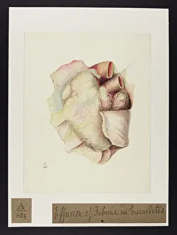 Unsigned: Effusion of Fibrine in Pericarditis