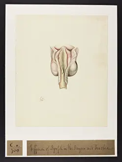 Layer: Effusion of Lymph in Larynx and Trachea