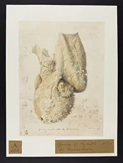 Lymph: Effusion of Lymph Within the Pericardium