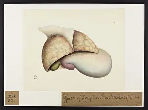 Membrane: Effusion of Lymph on Serous Membrane of Liver