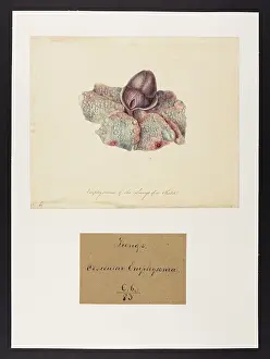Lungs: Emphysema of the Lungs