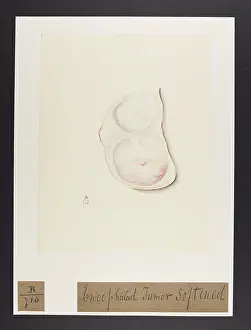 Ucl Library Services Digital Collections: Encephaloid Tumours in the Breast
