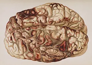 Revolver: Encircling Gunshot-Wound in Brain, 1898
