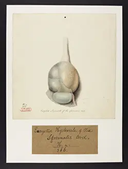 Cord: Encrusted Hydrocele of the Spermatic Cord