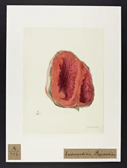 Blank: Endo-Carditis, Pericarditis