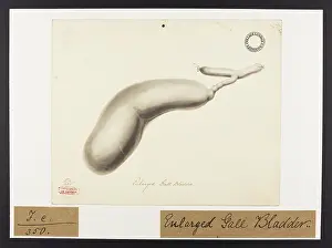 Gall: Enlarged Gall Bladder
